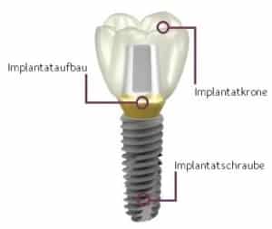 Schematischer Aufbau eines Zahnimplantats
