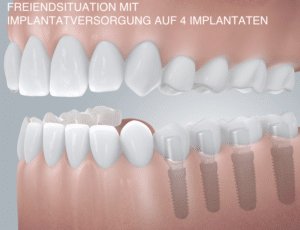 Freiendsituation mit Implantatversorgung auf 4 Zahnimplantaten