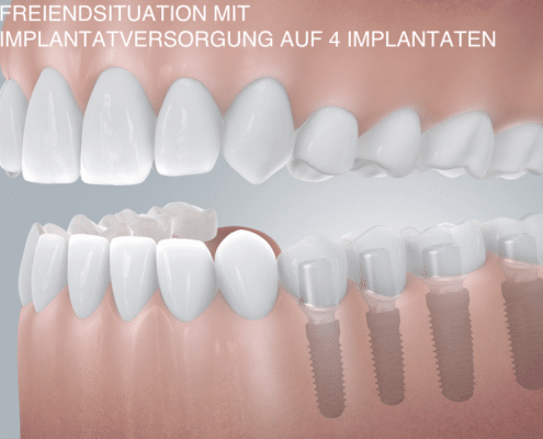 Freiendsituation mit Implantatversorgung auf 4 Zahnimplantaten