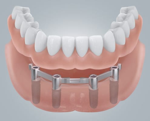 Eine Stegprothese auf 4 Zahnimplantaten