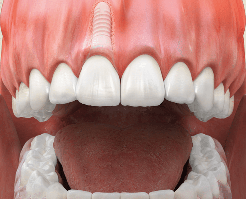 Beispiel: Versorgung einer Einzelzahnlücke an den Frontzähnen mit Versorgung durch ein Keramik-Zahnimplantat