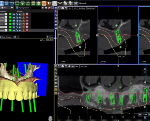schematischer Vorgang einer computergestützten Zahnimplantatplanung mit dem zuvor angefertigten 3D-Röntgenbild