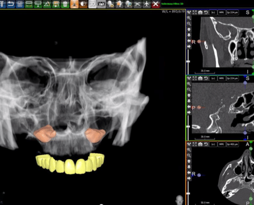 schematischer Vorgang einer computergestützten Zahnimplantatplanung mit dem zuvor angefertigten 3D-Röntgenbild